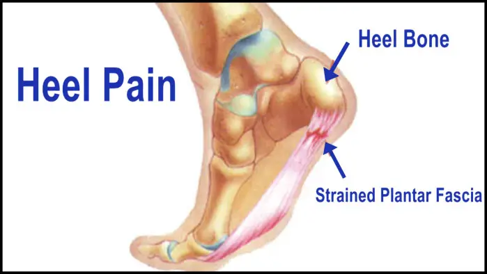 heel-pain