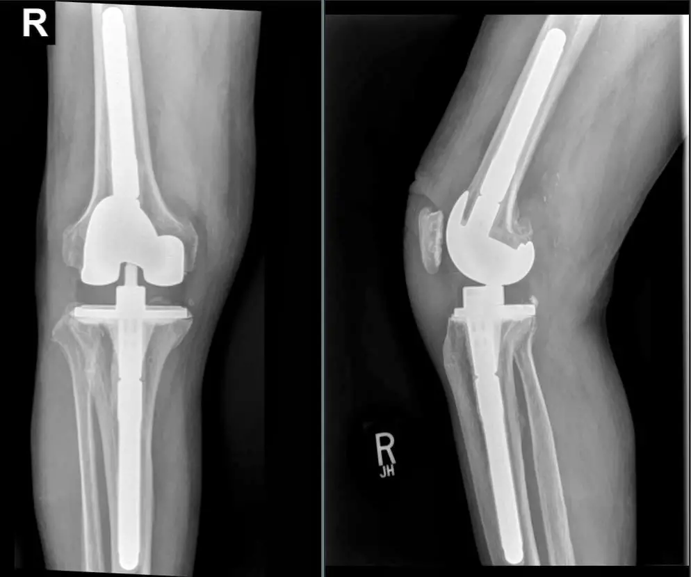 x-ray knee replacement stiffness